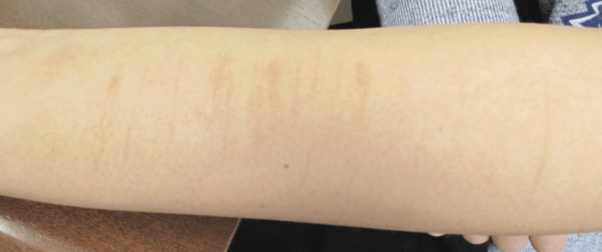 An Adolescent With a SelfInflicted Forearm/Wrist Cutting Injury